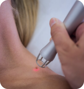 Видалення папілом 