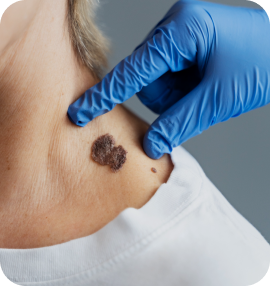 Видалення новоутворень шкіри від 1 см